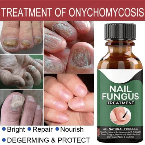 Nail Fungus Treatment Serum - Image 3