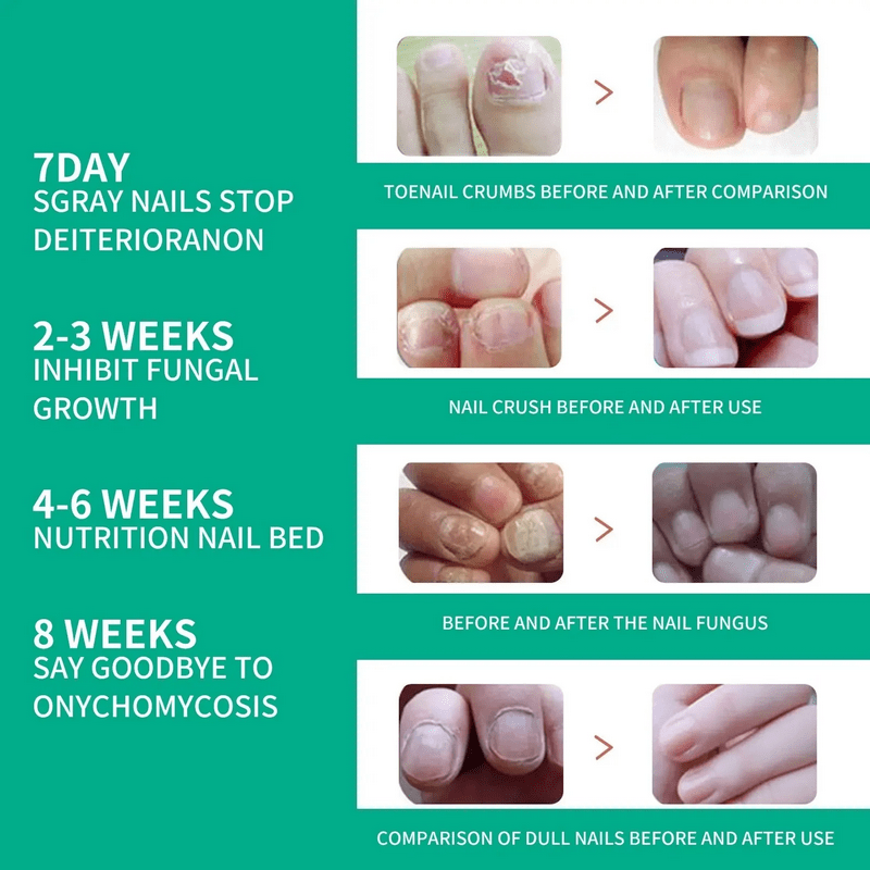 Nail Fungus Treatment Serum - Image 5